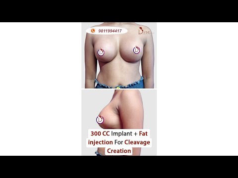 300 CC Silicone Implants Before and After | Fat Injection for Cleavage Creation Results