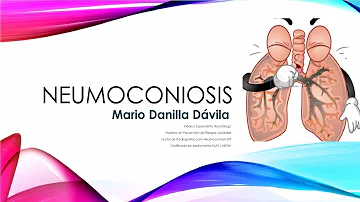 ¿Cuáles son los signos y síntomas de la neumoconiosis?