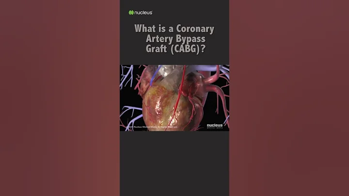 What is a Coronary Artery Bypass Graft (CABG)? #shorts - DayDayNews