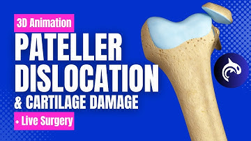 Patellar Dislocation and Cartilage Damage - 3D Animation + Live Surgery