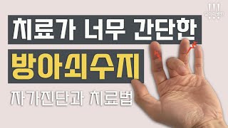 방아쇠수지, 간단한 주사로 대부분 좋아집니다  #방아쇠수지 #달려라병원 박재범