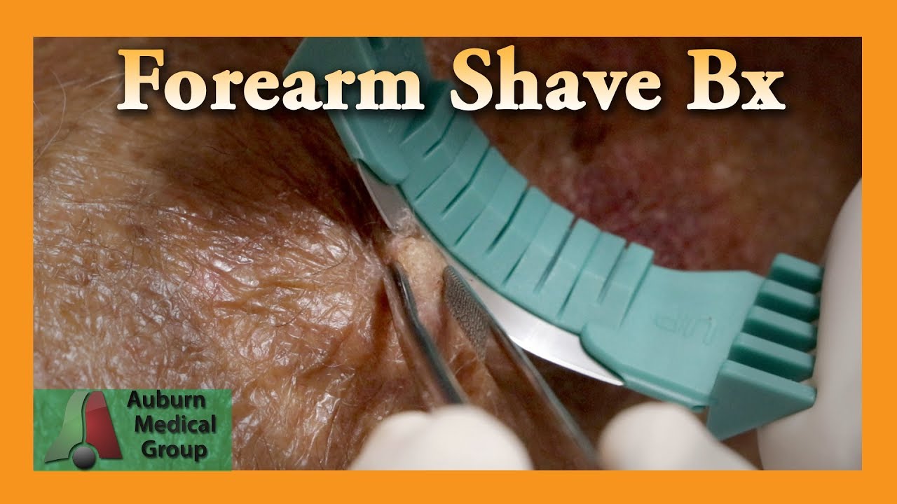 Forearm Shave Biopsy Auburn Medical Group YouTube Forearm Shave Biopsy Auburn Medical Group YouTube