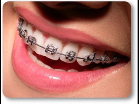 Donde puedo ponerme brackets baratos