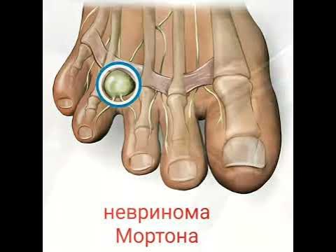 Невринома Мортона - YouTube
