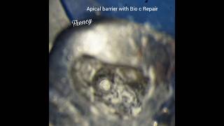 ReRct of 17,Apical barrier with Bio c Repair in palatal canal.calcified Mb and Db canal
