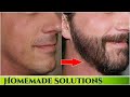 घनी दाढ़ी और मूंछ उगाने का असरदार उपाय | How Fix Patchy Beard & increase hair facial hair Grow