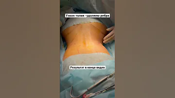 Формирование узкой талии с удалением ребер #пластическийхирург #рустамкурманбаев
