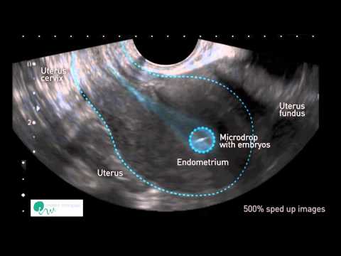 Video: Attaccamento dell'embrione all'utero in quale giorno si verifica?