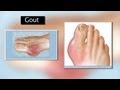 Gout - Mayo Clinic