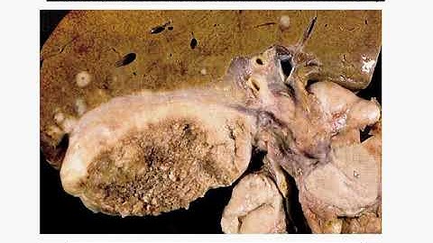 CAP education session Liver and biliary tract cancer Dr Oyedele 2013