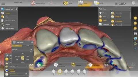 6 unit anterior case designed in 10 minutes