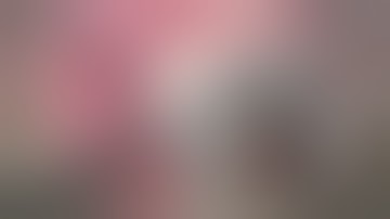 secondary lens via haptic tuck-modified scleral glued technique