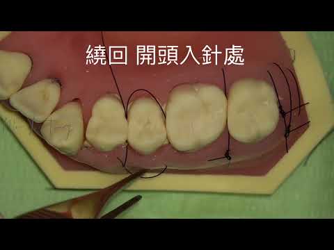 Single Sling Suture