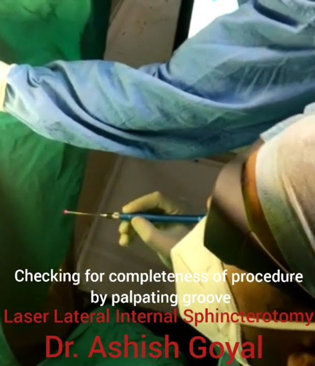 Laser Treatment For Fissure In Ano Dr Ashish Goyal Pratapnagar laser-treatment-for-fissure-in-ano-dr-ashish-goyal-pratapnagar