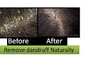 Remove dandruff at home how to remove dandruff quickly  naturally  starnaturalbeauties