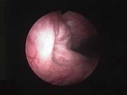 fibroscopia nasal en hipertrofia amigdala lingual mpg youtube fibroscopia nasal en hipertrofia amigdala lingual mpg youtube