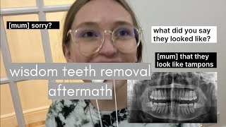 wisdom teeth vlog | Chaz