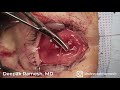 Capture de la vidéo Evisceration With Silicone Implant