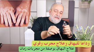 البهاق وعلاجه النهائي والمجرب من مجربات زمان