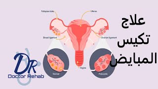 علاج تكيس المبايض