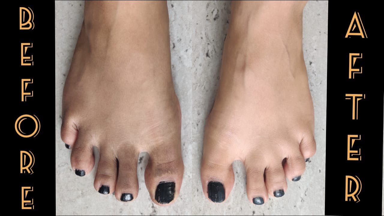 How To Remove Tan From Hands Legs Neck And Face Overnight Youtube youtube