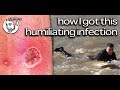 HOW I GOT THIS HUMILIATING INFECTION! | STEVE-O