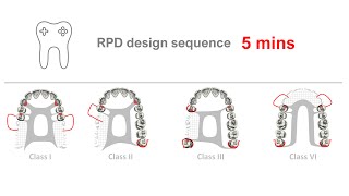 RPD Design in 5 mins
