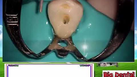 NỘI NHA 14  Mở tủy răng nanh hàm dưới Carlos Praco