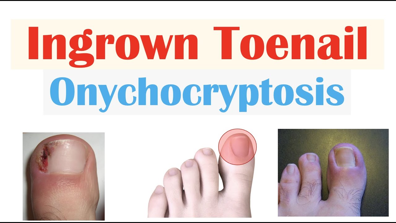 Nail Diseases and Disorders, Nail Signs Clues To Health Problems In  Children - YouTube