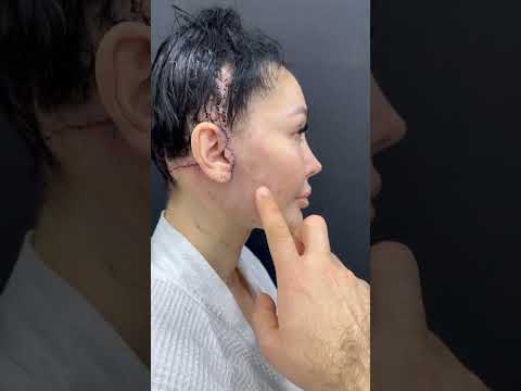 Первые сутки после подтяжки лица