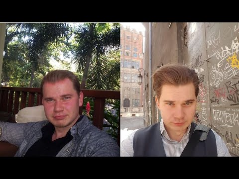 what-happens-when-you-stop-minoxidil:-from-my-experince