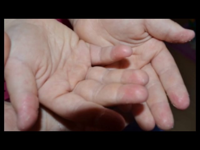 Шелушится кожа на ладонях и пальцах - фото