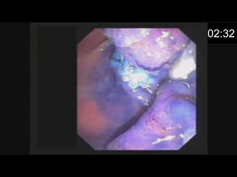 Эндоскопическое удаление аденомы Фатерова сосочка методом папиллэктомии