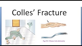 Orthopedics 130 Colles fracture Dorsal tilt Complications Dinner fork deformity Darrack Sudeck