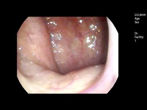 軟口蓋ミオクローヌス治療後