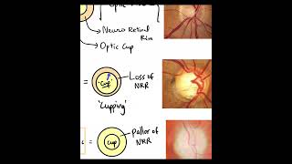 Normal Disc vs. Glaucomatous Disc vs. Atrophic Disc #Basics #Shorts