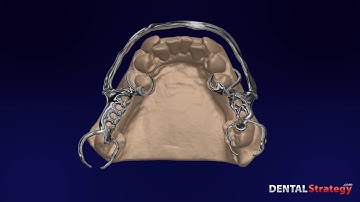 215 - Lower RPD Class III mod 1