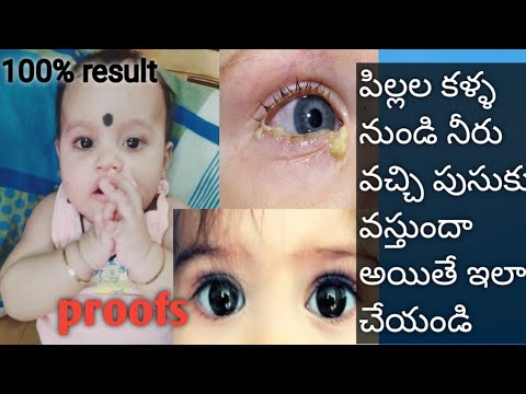 Baby watery  sticky eyes tips  baby eye infection tips at home  how to cure baby eye watering
