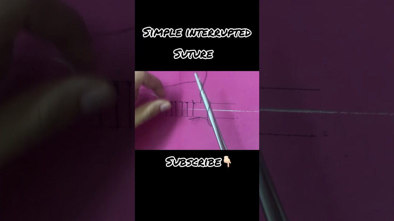 Simple interrupted suture 