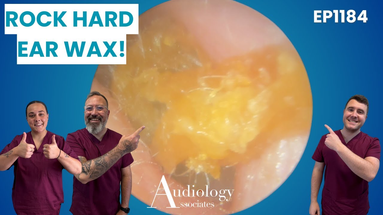 Deep Rocks For Ear Rock Hard Wax Pulled from Narrow Ear Canal - EP1184 - YouTube