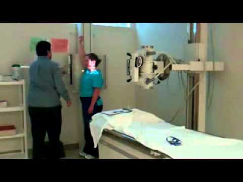 odontoid fracture odontoid fracture