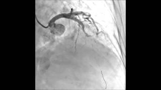 Thrombus Aspiration