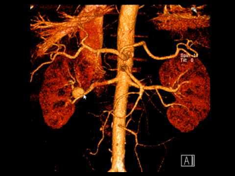 КТ ангиография при аневризме почечной артерии