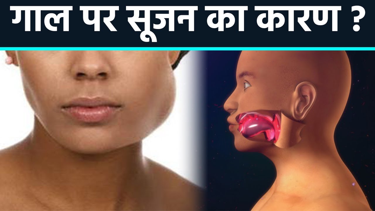 गाल पर सूजन के कारण, Salivary Gland Infection से लेकर Angioedema का खतरा | Boldsky
