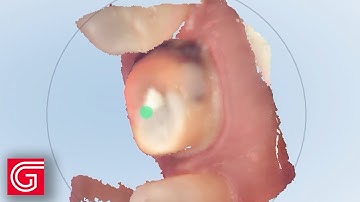 How to Accurately Scan a Lower Molar Preparation