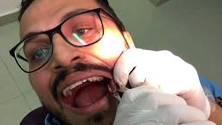 Upper left wisdom self extraction procedure..