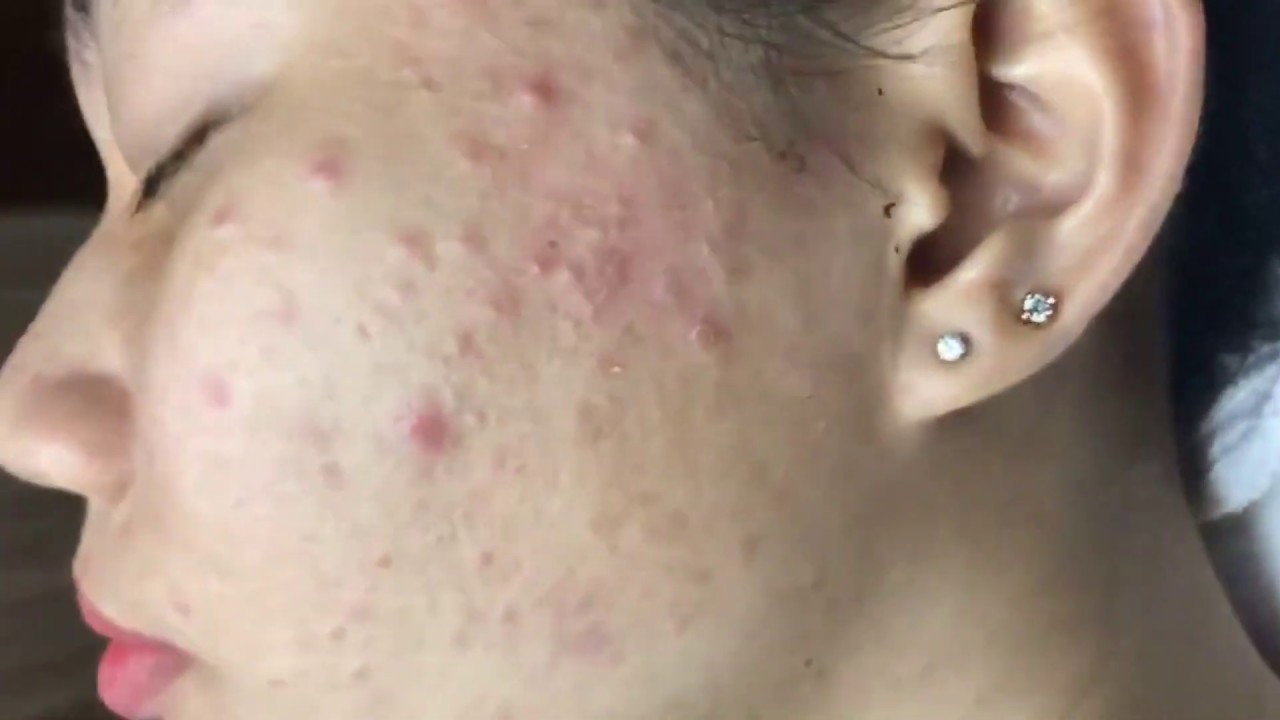 The Blackhead Extractor & Tweezer Dance YouTube