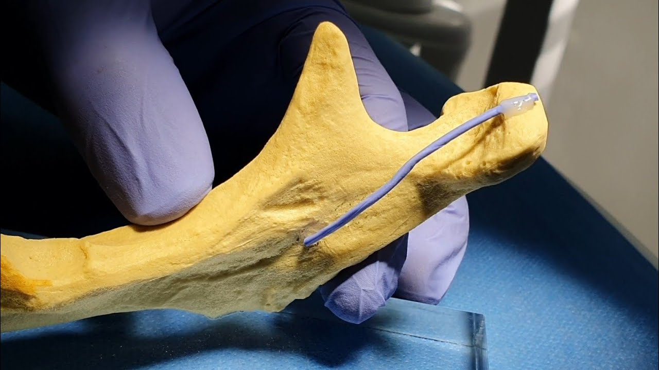 Mandibular Anestezi Nasıl Yapılır ? Nelere Dikkat Edilir ?