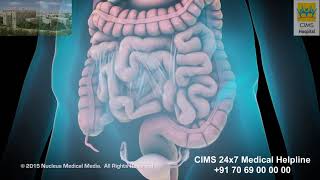 Laparoscopic Lysis of Abdominal Adhesions – CIMS Hospital