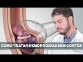 Ligadura Elástica: Como Tratar Hemorroidas Sem Cirurgia